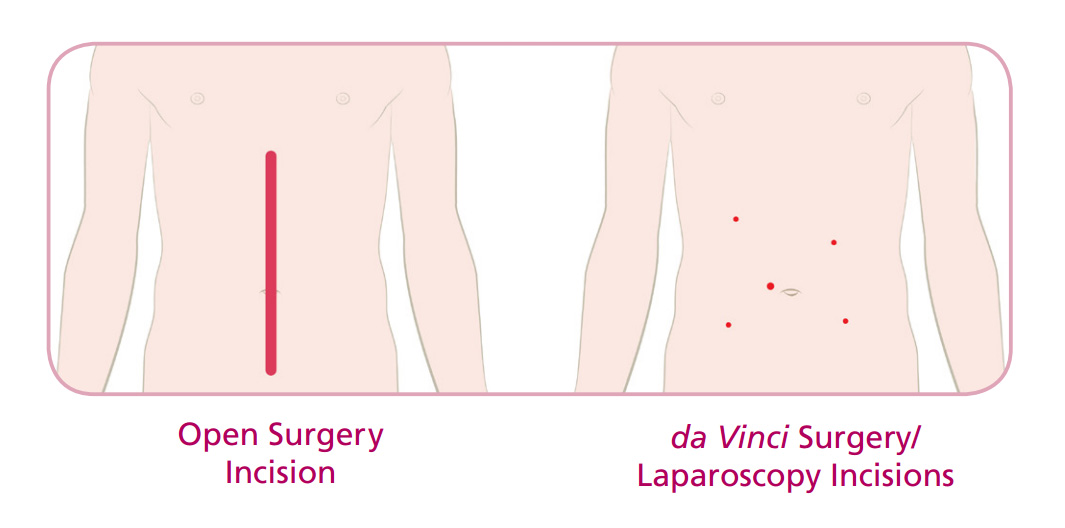 HCA Virginia Colorectal Cancer Robotic Minimally-Invasive Surgery Comparison