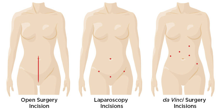 daVinci Robotic Surgery Gynecologic Oncology Cancer Female Reproductive Hysterectomy Ovary Fallopian Tube Uterus Cervix Boardman Ford West Guerette